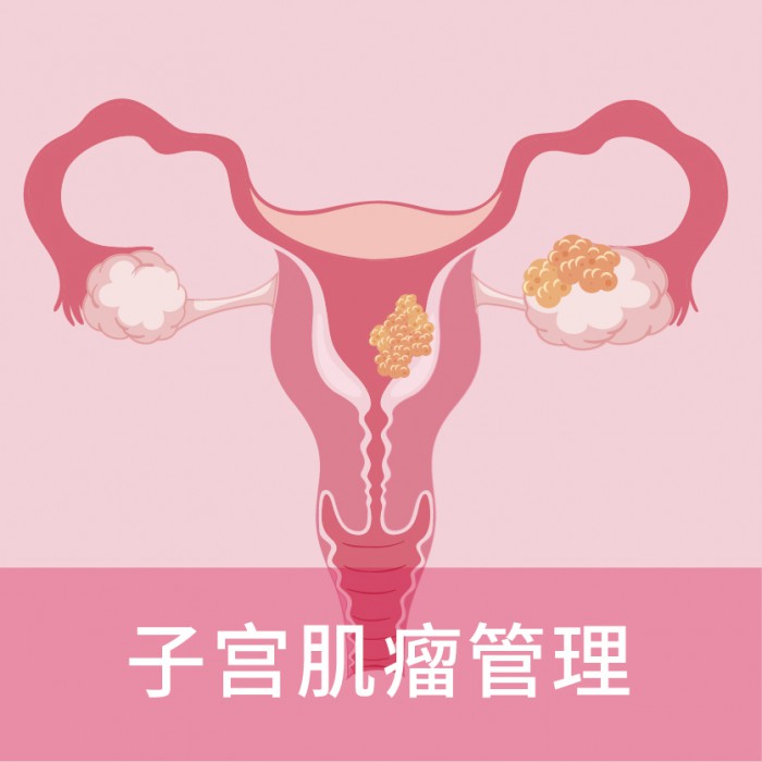 子宫肌瘤管理