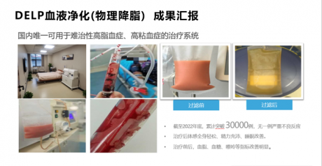 体外脂蛋白清除