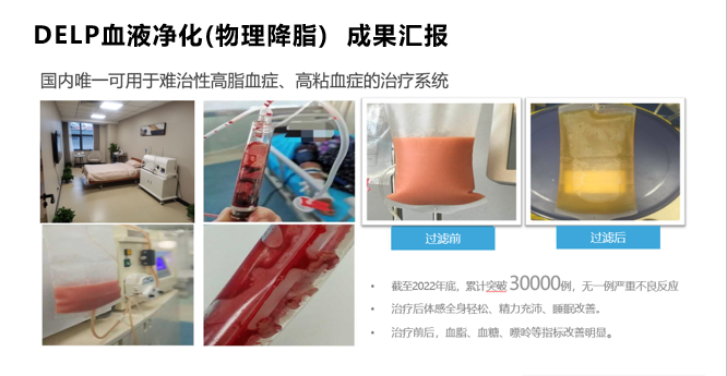 体外脂蛋白清除
